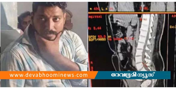 ഗർഭ നിരോധന ഉറകളിൽ എംഡിഎംഎ നിറച്ച് മലദ്വാരത്തിൽ ഒളിപ്പിച്ചു; കൊല്ലത്ത് യുവാവ് പിടിയില്‍