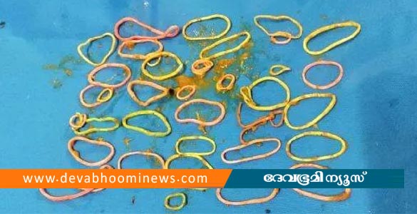 തിരുവനന്തപുരത്ത് യുവതിയുടെ വയറ്റില്‍ നിന്ന് ഓപ്പറേഷനിലൂടെ കണ്ടെടുത്തത് 41 റബ്ബര്‍ ബാന്‍ഡുകള്‍