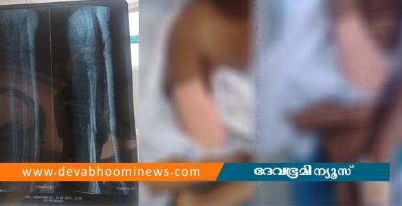 പാലക്കാട് ജില്ലാ ആശുപത്രിയില്‍ ചികിത്സാപ്പിഴവെന്ന് പരാതി; 9 വയസ്സുകാരിയുടെ കൈ മുറിച്ചുമാറ്റി
