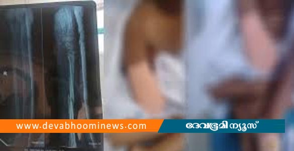 പാലക്കാട് കുട്ടിയുടെ കൈ മുറിച്ച് മാറ്റിയ സംഭവം; രണ്ട് ഡോക്ടര്‍മാര്‍ക്ക് സസ്‌പെന്‍ഷന്‍
