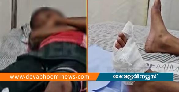 കോട്ടക്കലിൽ ഉറങ്ങാന്‍ കിടന്ന എട്ടുവയസ്സുകാരനെ കിടപ്പു മുറിയില്‍ കയറി കടിച്ച് തെരുവുനായ