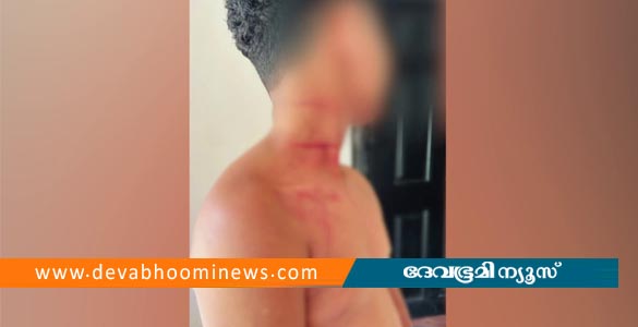 ചെരുപ്പ് മാറി ഇട്ടു; കൂടരഞ്ഞിയിൽ ആദിവാസി വിദ്യാർഥിക്ക് ക്രൂരമർദനം