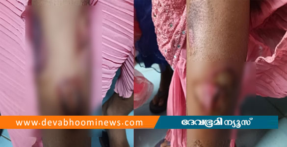 മലപ്പുറത്ത് കുട്ടികളെ ചട്ടുകം കൊണ്ട് പൊള്ളിച്ച് രണ്ടാനമ്മയുടെ കൊടും ക്രൂരത