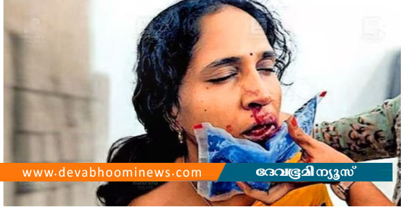 ക്ലാസിനിടെ ഗെയിം കളിക്കുന്നത് വിലക്കി; വിദ്യാർഥിയുടെ മർദനമേറ്റ് അധ്യാപികയ്ക്ക് ഗുരുതര പരിക്ക്