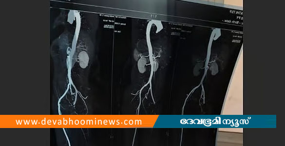 ശസ്ത്രക്രിയക്കിടെ കാലിന്&zwj;റെ ഞരമ്പ് മുറിഞ്ഞു; മഞ്ചേരി മെഡിക്കല്&zwj; കോളജില്&zwj; ഗുരുതര ചികിത്സാ പിഴവ്
