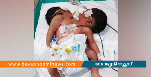 അപൂർവ്വങ്ങളിൽ അപൂർവ്വം: ഒഡിഷയിൽ രണ്ട് തലകളുമായി കുഞ്ഞ് ജനിച്ചു