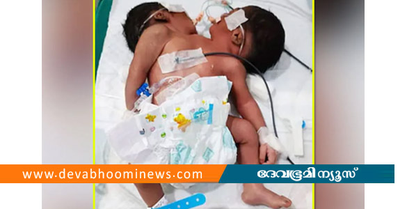 ഒഡീഷയിൽ രണ്ട് തലകളുമായി ജനിച്ച കുഞ്ഞ് ഒരാഴ്ചയ്ക്കുശേഷം മരിച്ചു
